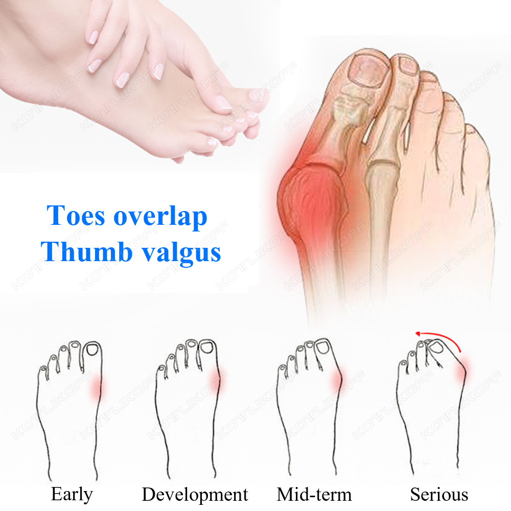 تو واقية أصابع فاصل سيليكون ال - مراجعة Toe Separator Silicon وسعره